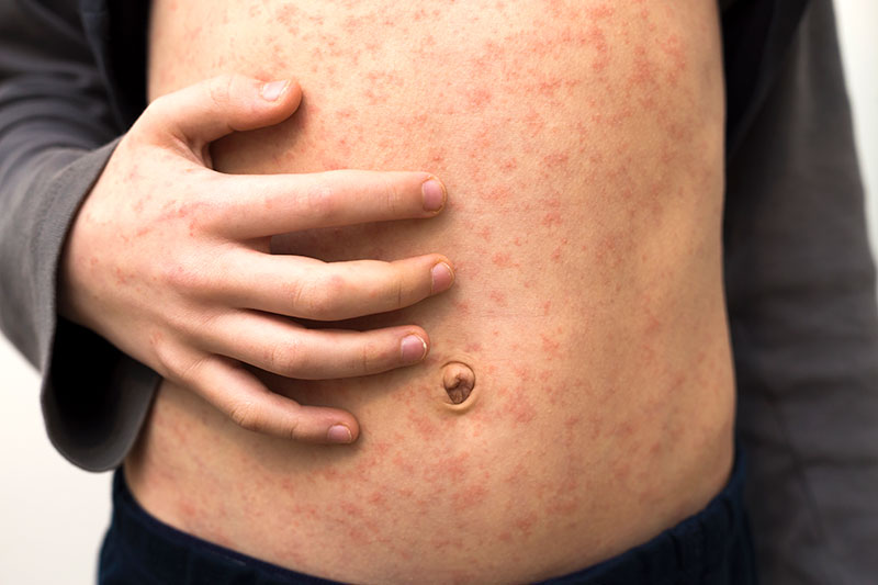 child with measles rash on abdomen and hands